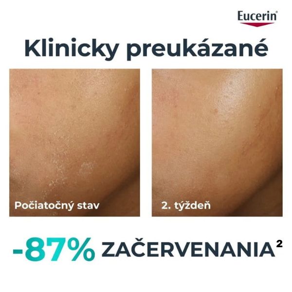 Eucerin DermoPure CLINICAL Obnovujúci krém a klinické štúdie, ktoré preukazujú redukciu začervenania