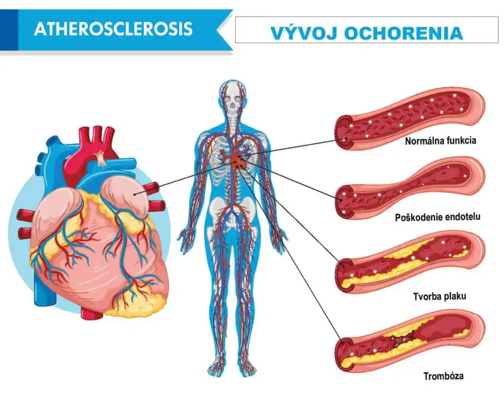Vyvoj arterosklerozy 