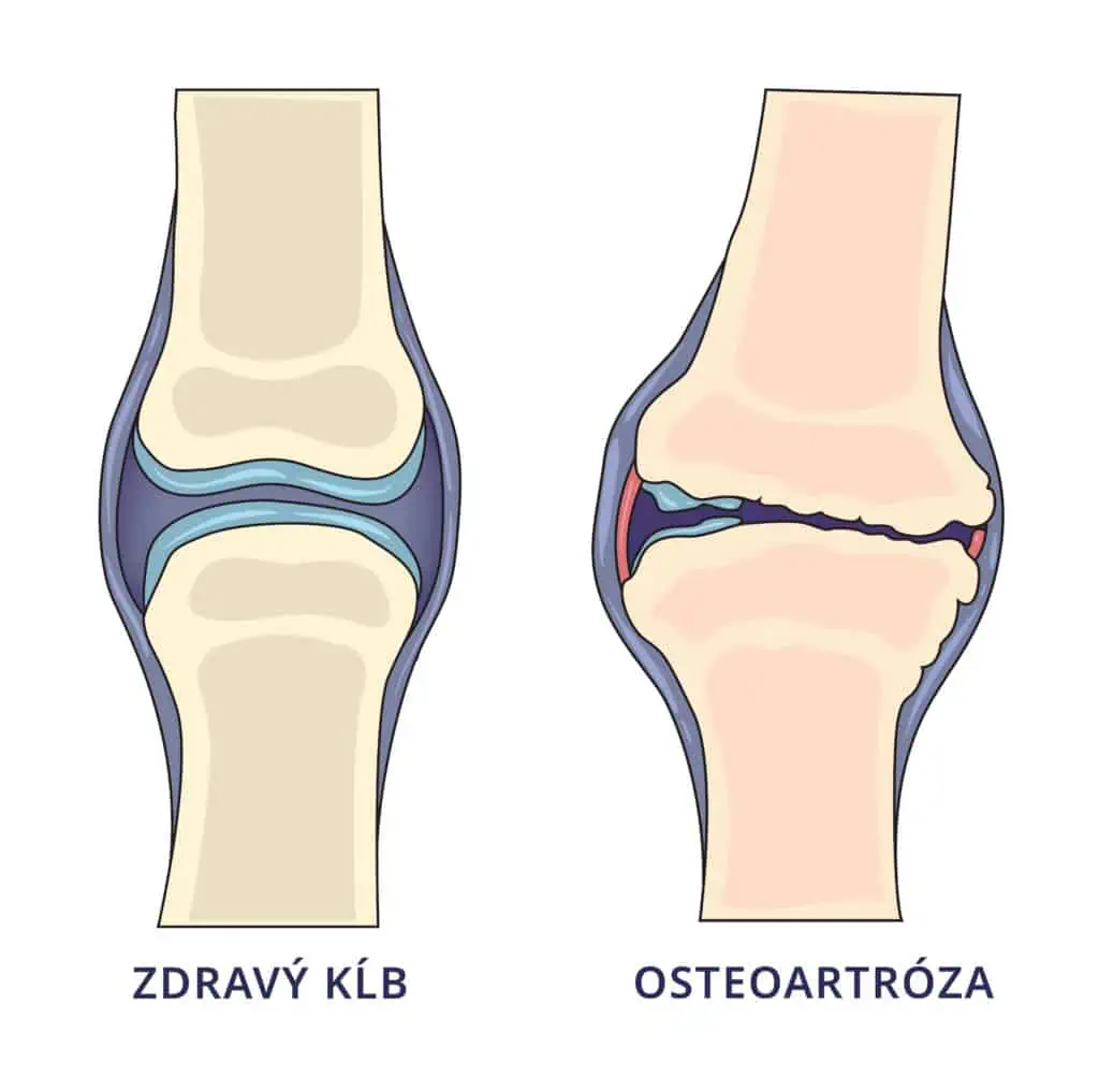 Co pomaha na Osteoartrózu?