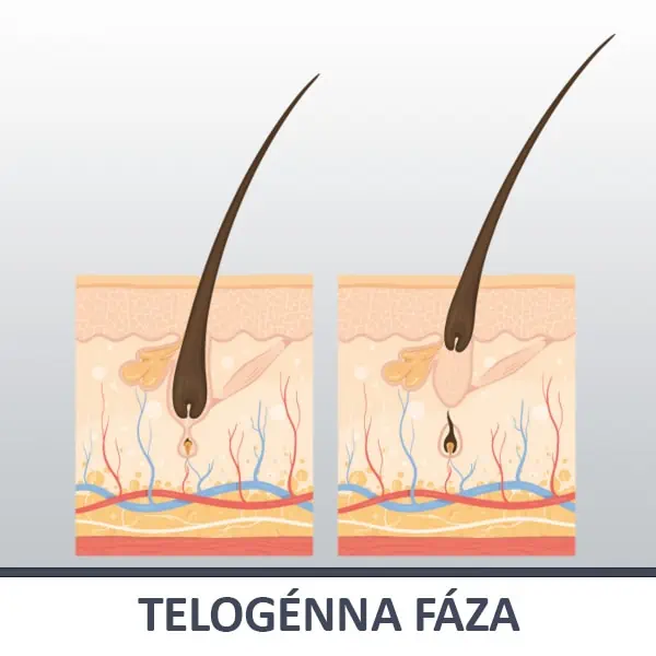 3. Telogénna fáza (fáza pokoja), kedy vlasy vypadnú a tvoria sa nové