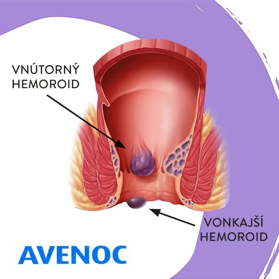 Keď vás trápia hemoroidy, liečba bude závisieť od ich lokácie