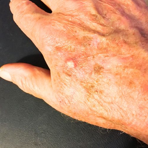 Čo je aktinická keratóza a prečo si vyžaduje prevenciu