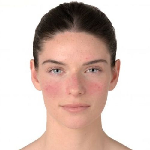 Prečo si začervenaná pleť zamiluje opalovací krém BIODERMA Photoderm AR SPF 50+