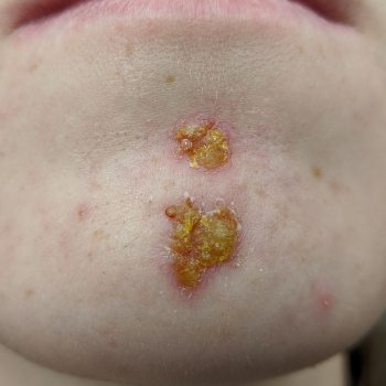 Impetigo