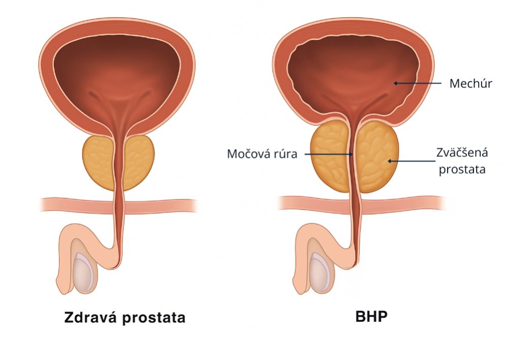 benigna hyperplazia prostaty