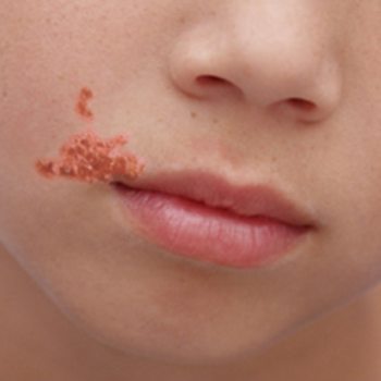 impetigo u deti