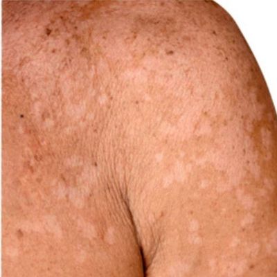 Nizoral šampón je vhodný pri seboroickej dermatitíde alebo pityriasis versicolor