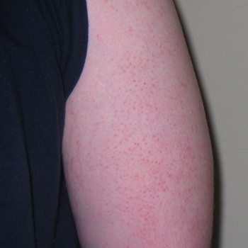 Keratoza Pilaris folikularna keratoza obrazky
